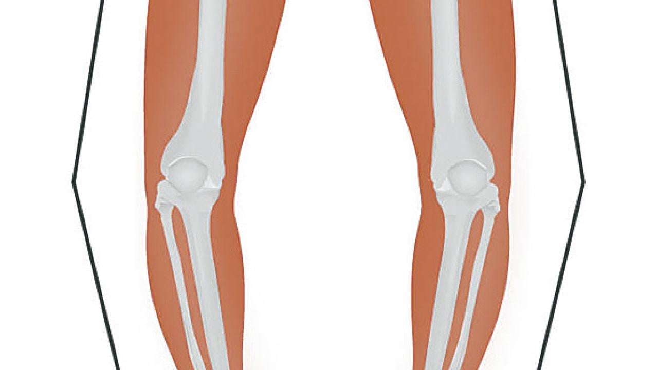 O形腳與步姿關係