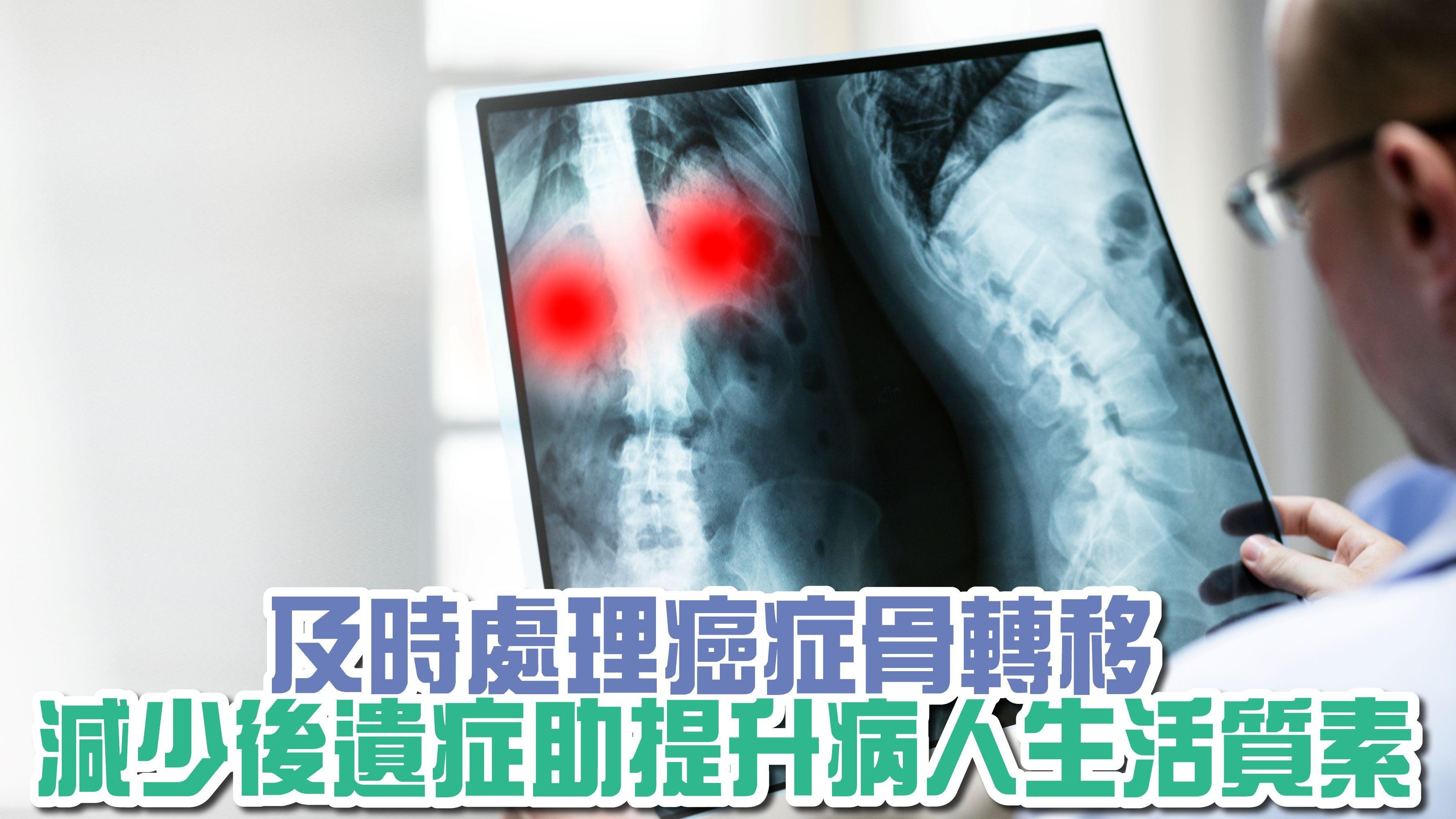 及時處理癌症骨轉移 減少後遺症助提升病人生活質素