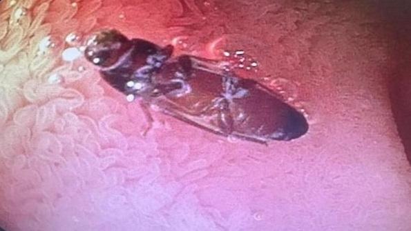 內窺鏡檢查發現，男子小腸裡有一隻活蟑螂。(互聯網)