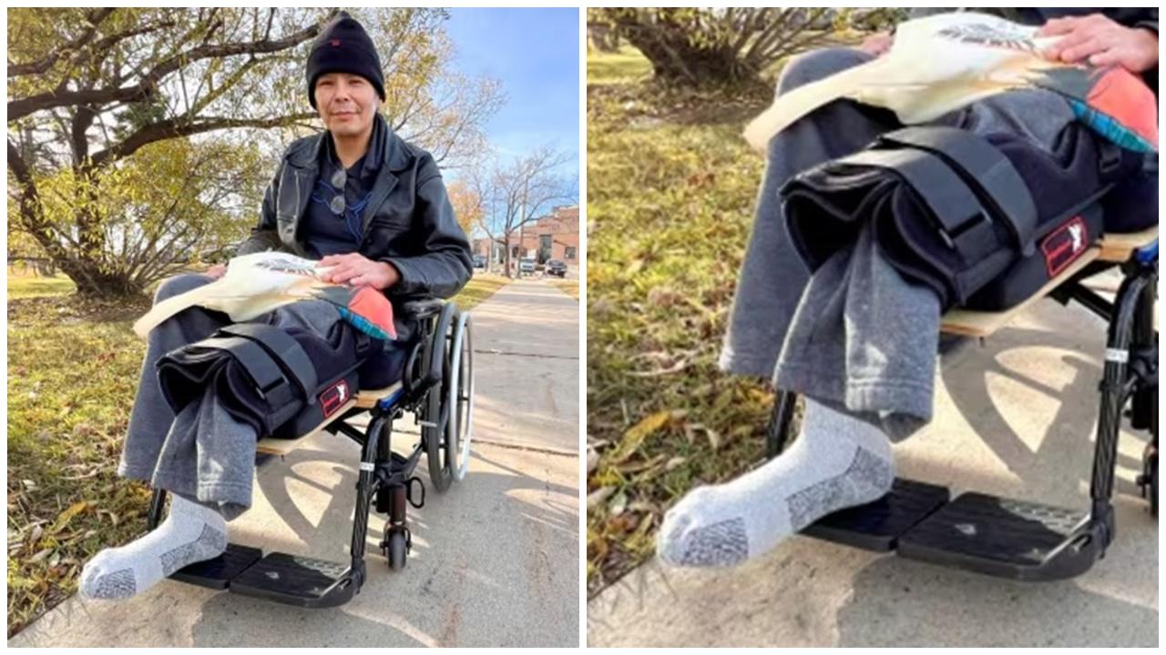 加國男做右腿截肢手術，醒來驚見鋸錯腳。(X)