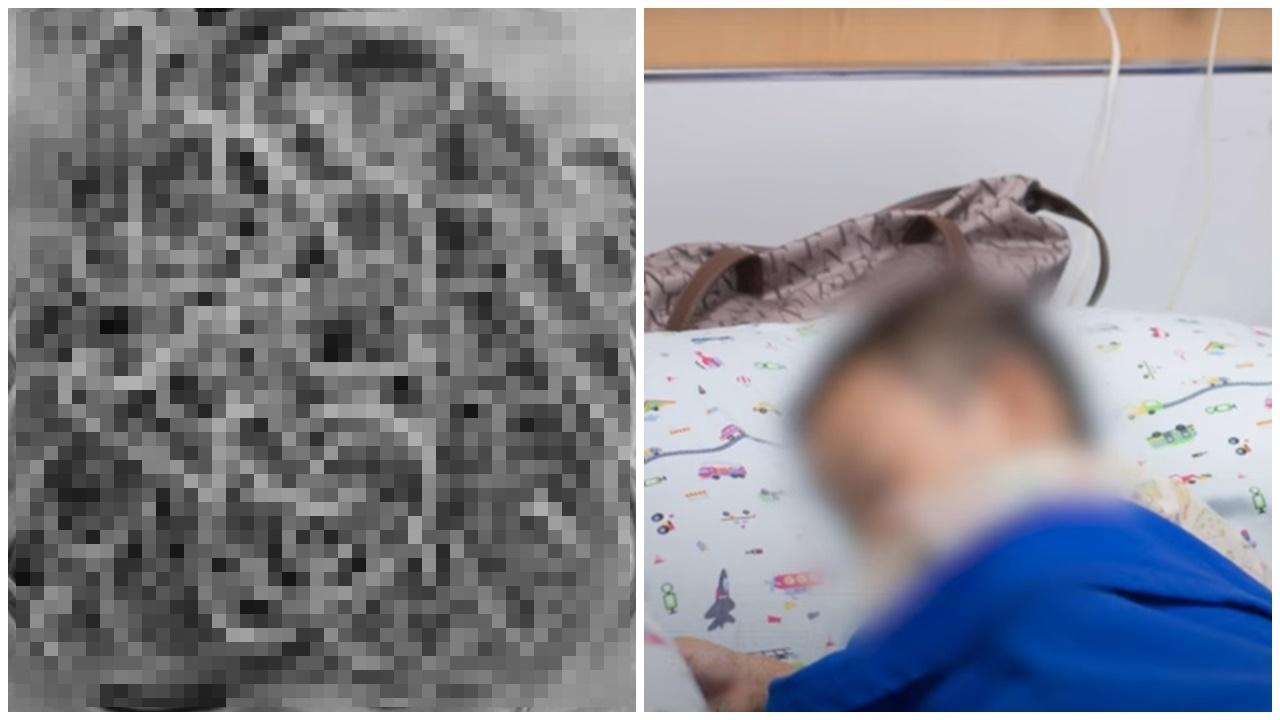 2歲童發燒腹瀉休克，開刀抽出百條活蛔蟲多如一盤意粉。(網上圖片)