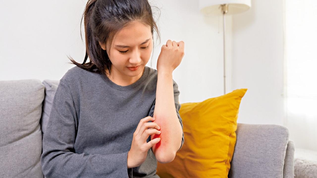 天氣轉 小心濕疹復發