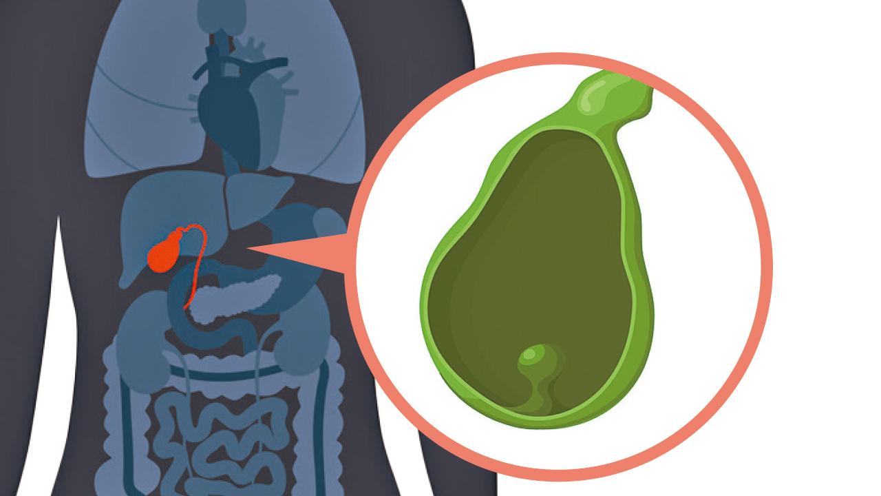 膽息肉愈大愈惡 1cm是手術臨界點
