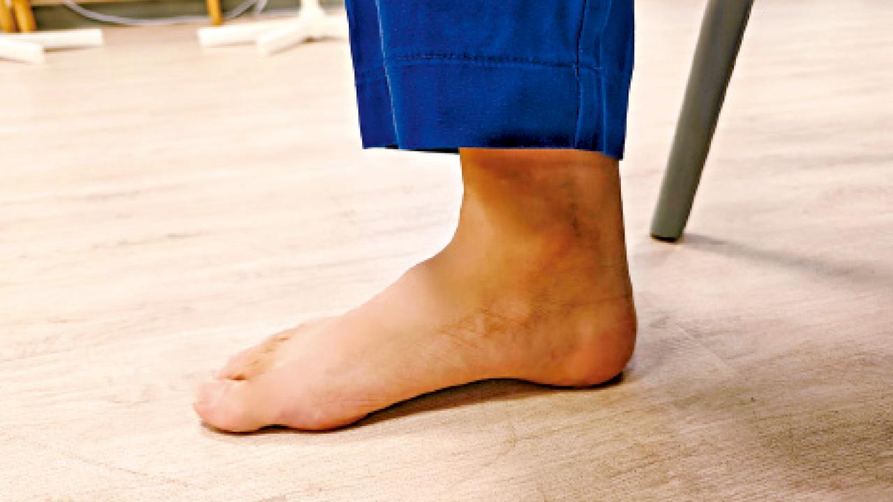 從扁平足到X形腳