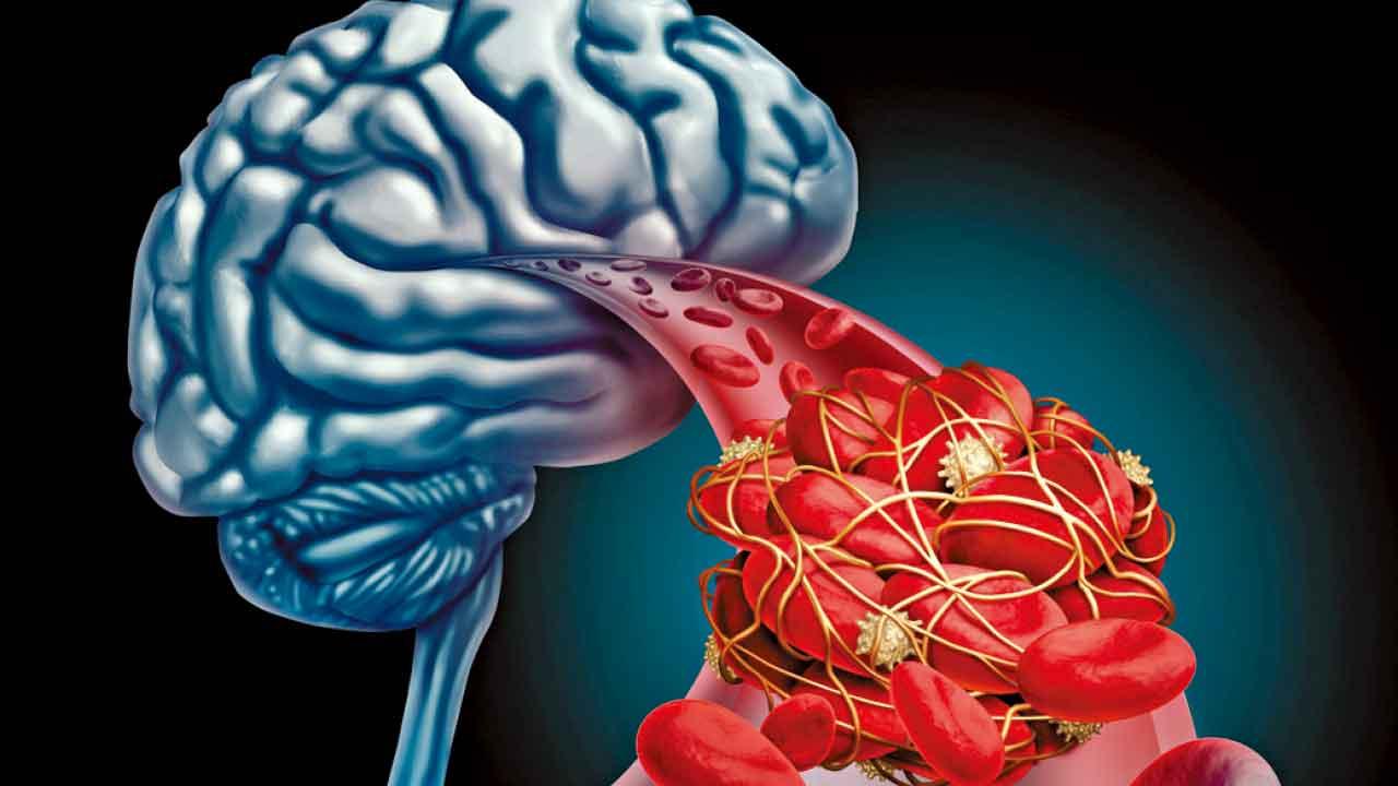 脂肪因子FABP4 在缺血性中風中的作用及治療潛力