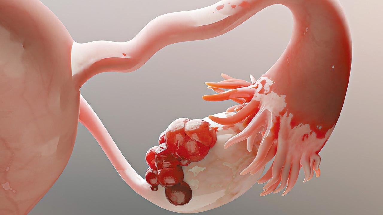 朱古力瘤 可致不育