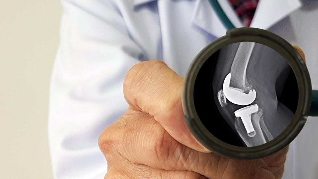 根據文獻統計，約有1%的患者術後會遭遇感染問題，進而演變為人工關節感染骨髓炎。