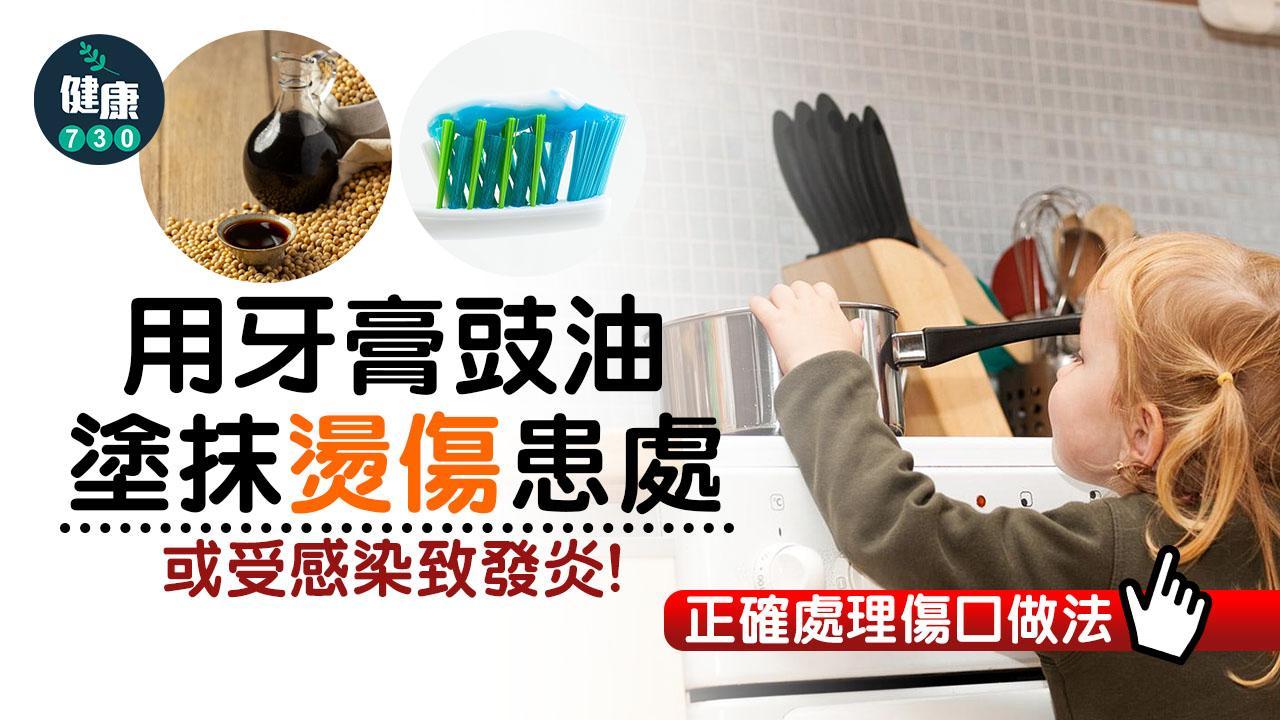 燙傷處理｜用牙膏豉油塗抹患處或受感染致發炎(附正確方法)