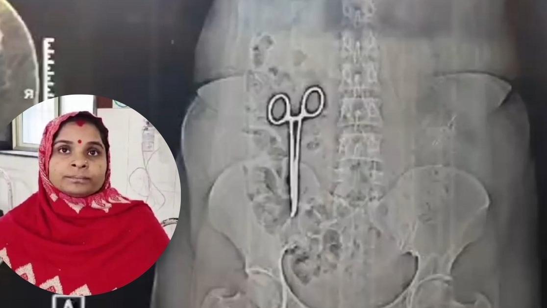 印度婦胃部手術後持續腹痛2年　醫生在結腸發現醫療用剪刀