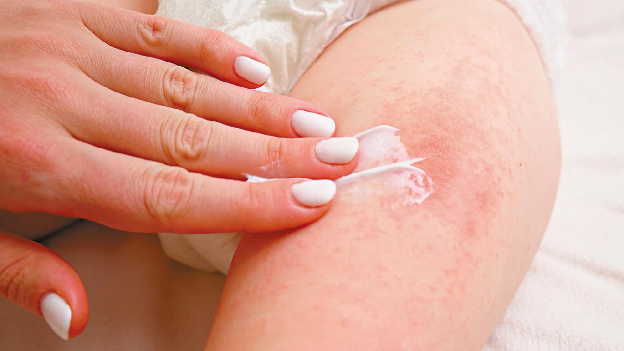 過度清潔 兒童易過敏