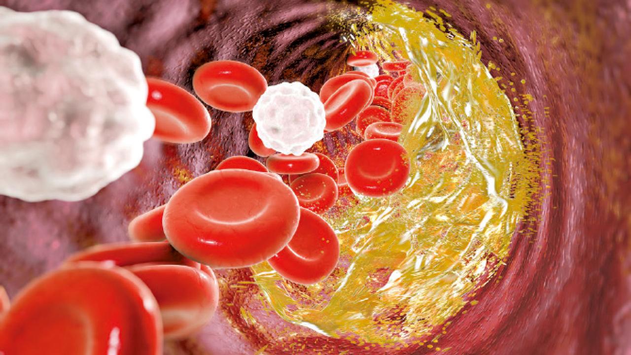 膽固醇之謎：PCSK9抑制劑的救贖