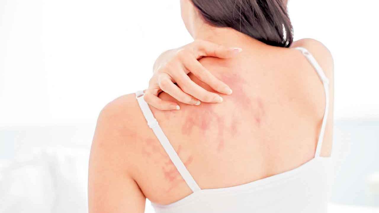 長期濕疹可致慢性痕癢 生活質素如中風