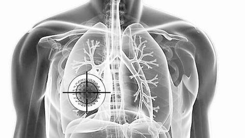 食療抵抗生活中的肺癌殺機 
