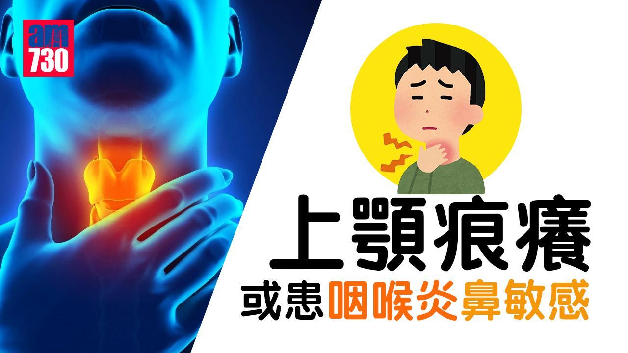 口腔上顎痕癢或患咽喉炎鼻敏感 附預防方法（am730製圖）