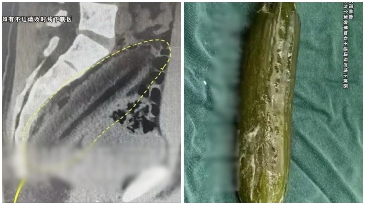 江蘇男15厘米青瓜塞肛門，堅稱誤信治便秘偏方。(微博)