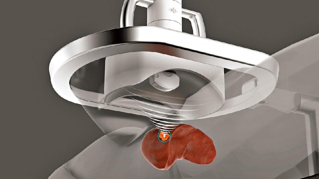 醫肝癌 有錢先有得揀？