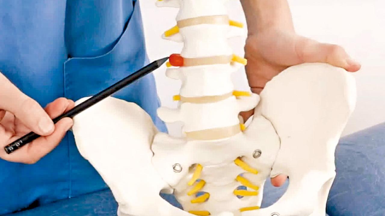 椎間盤突出的種類