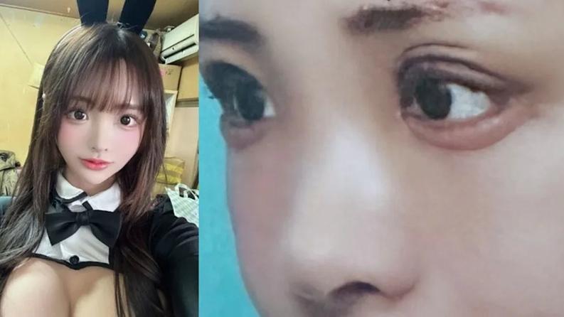 AV女優白浜希整容失敗變「三眼皮」 宣布無法工作