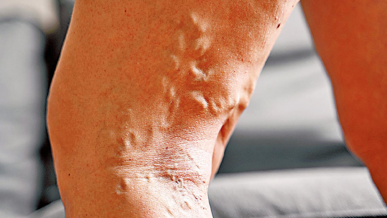 超聲波引導微創手術 根治靜脈曲張