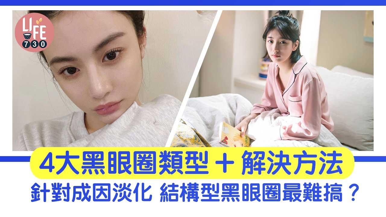 黑眼圈消除方法｜天然有效淡化4大類 結構型最難搞？（am730製圖）