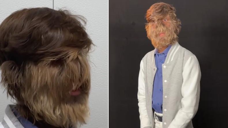 帕蒂達爾患上罕見先天性遺傳多毛症(Hypertrichosis)，俗稱「狼人綜合症」。(互聯網)