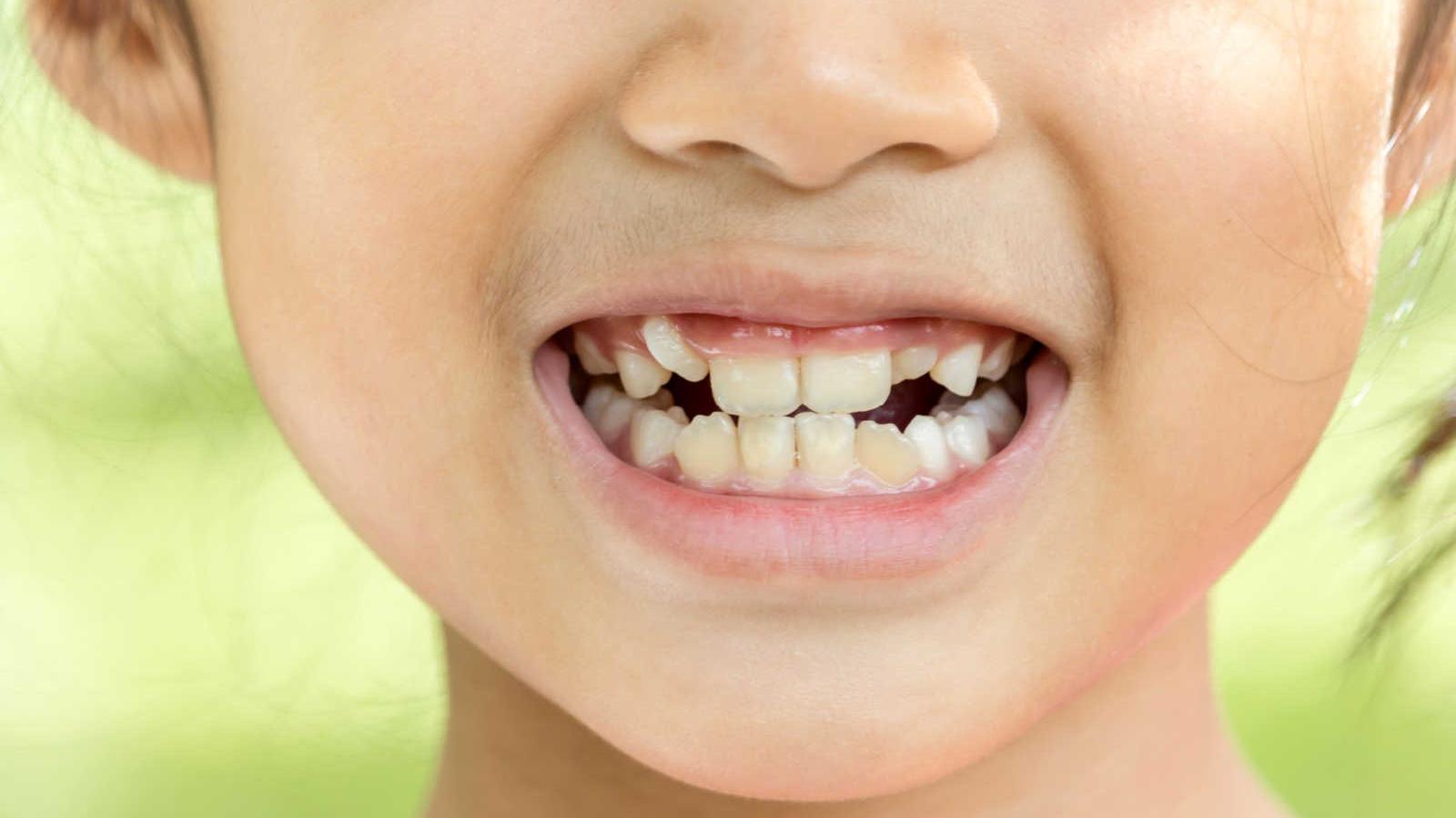 天天刷牙還是黃？揭開小朋友牙齒變色的真相