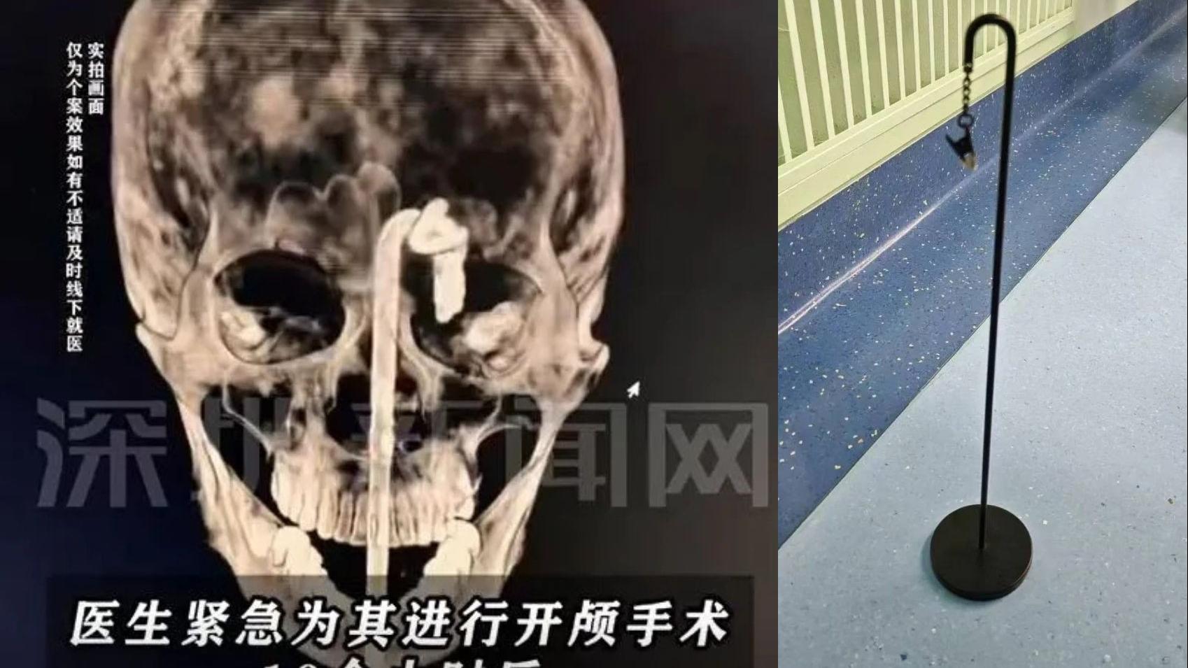 內地男酒後摔倒鐵桿插入口　直穿顱內緊急送院搶救