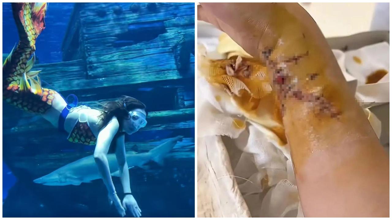 「美人魚」鯊魚咬手縫逾百針致10級傷殘，驚悚畫面曝光。(微博)