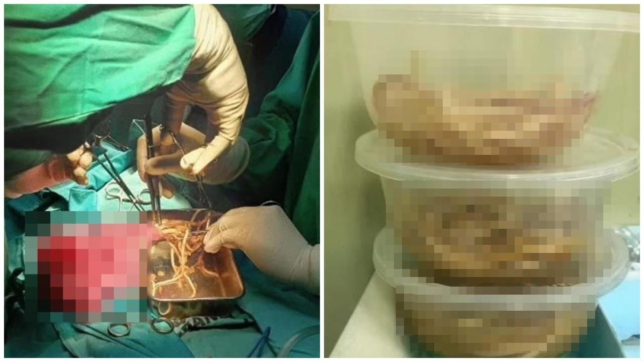 3歲男童腹脹便秘求醫，剖腹擠出3碗蛔蟲。(X)