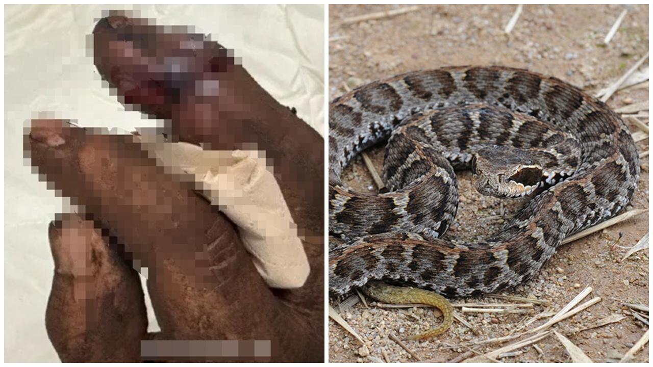 被蛇咬用咀啜毒？杭州漢手指發脹變黑緊急送院。