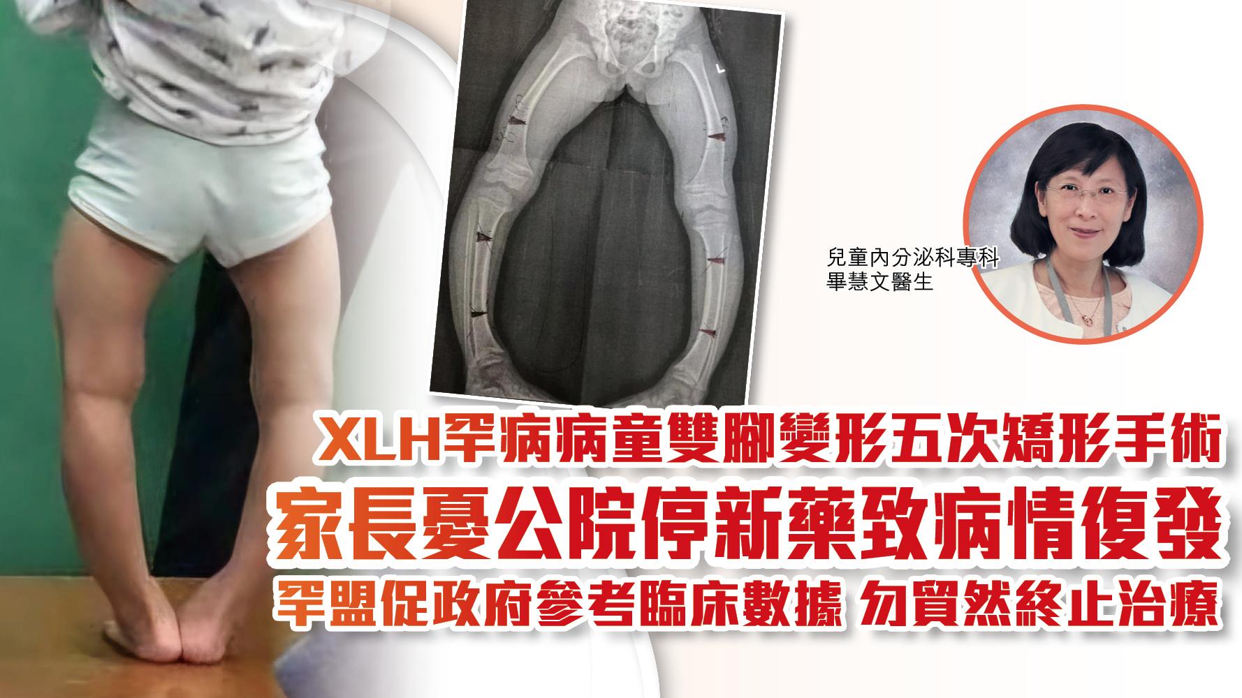 XLH罕病病童雙腳變形五次矯形手術 家長憂公院停新藥致病情復發 罕盟促政府參考臨床數據 勿貿然終止治療