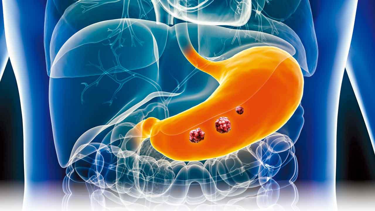基因組測序 腸化生類器官生物庫 助揪早期胃癌