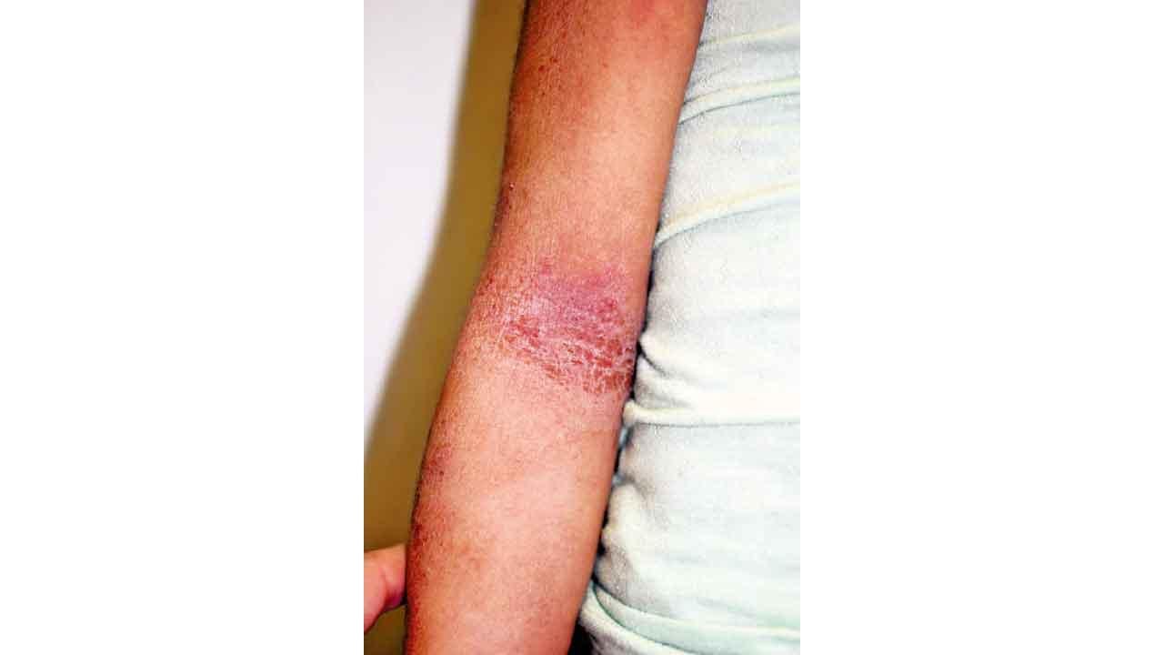 兩年前預測居然成真！嬰兒濕疹後遺症(上)