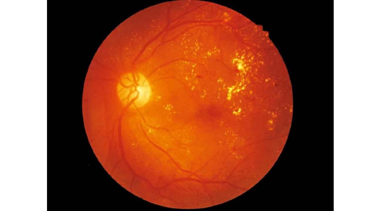 糖尿為甚麼會走上眼？