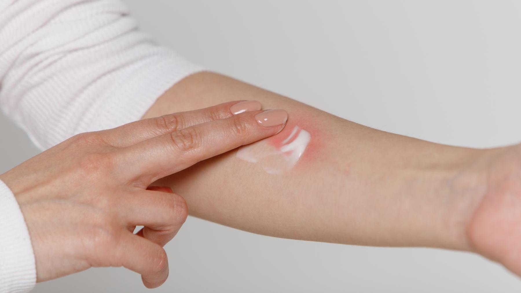 林口長庚醫院皮膚科盧俊瑋醫生提醒，皮膚外用藥雖然僅擦於皮膚表面，但還是要正確使用，亂用藥不但無法加速痊癒，反而可能導致額外的皮膚傷害。