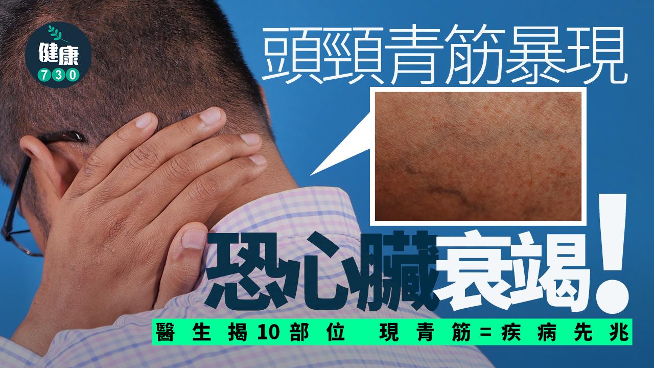 頭頸 青筋 心臟衰竭 心臟病 靜脈 血管 靜脈曲張