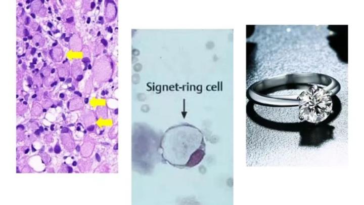胃印戒細胞癌（Signet-ring cell carcinoma,SRCC）是胃癌中的一種特殊類型，外形酷似戒指。