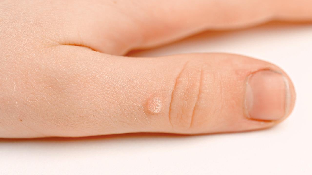 疣具傳染力 41%患者無處理 醫生︰共用毛巾增交叉感染風險