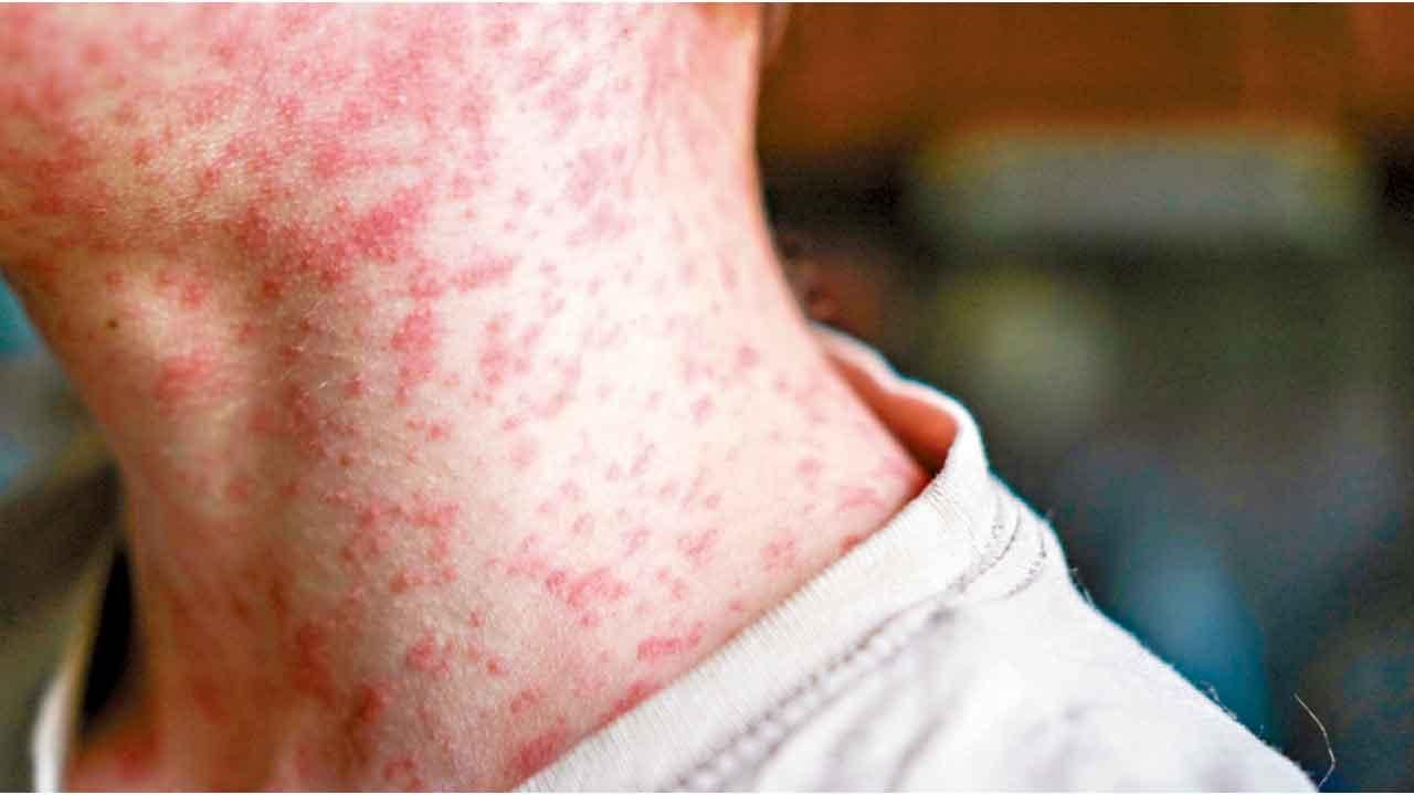 讓美國再次爆發麻疹疫情？