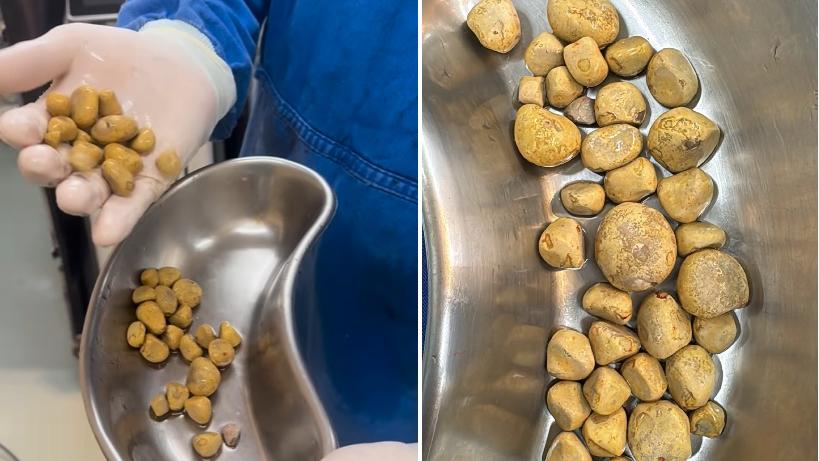 巴西男日喝3公升可樂　膀胱取出35粒大結石