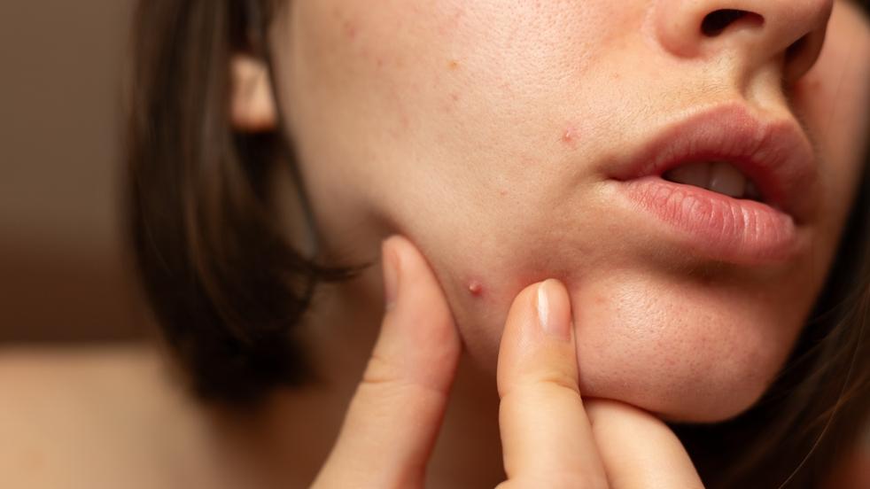 「藥物性食道炎」是自限性的疾病，大部分病人在適當的治療之後都會恢復。