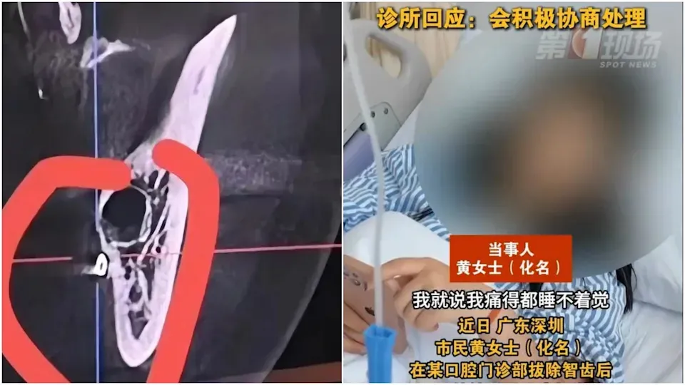 內地女拔智齒後劇烈頭痛多日　覆診驚見嘴裡殘留手術針