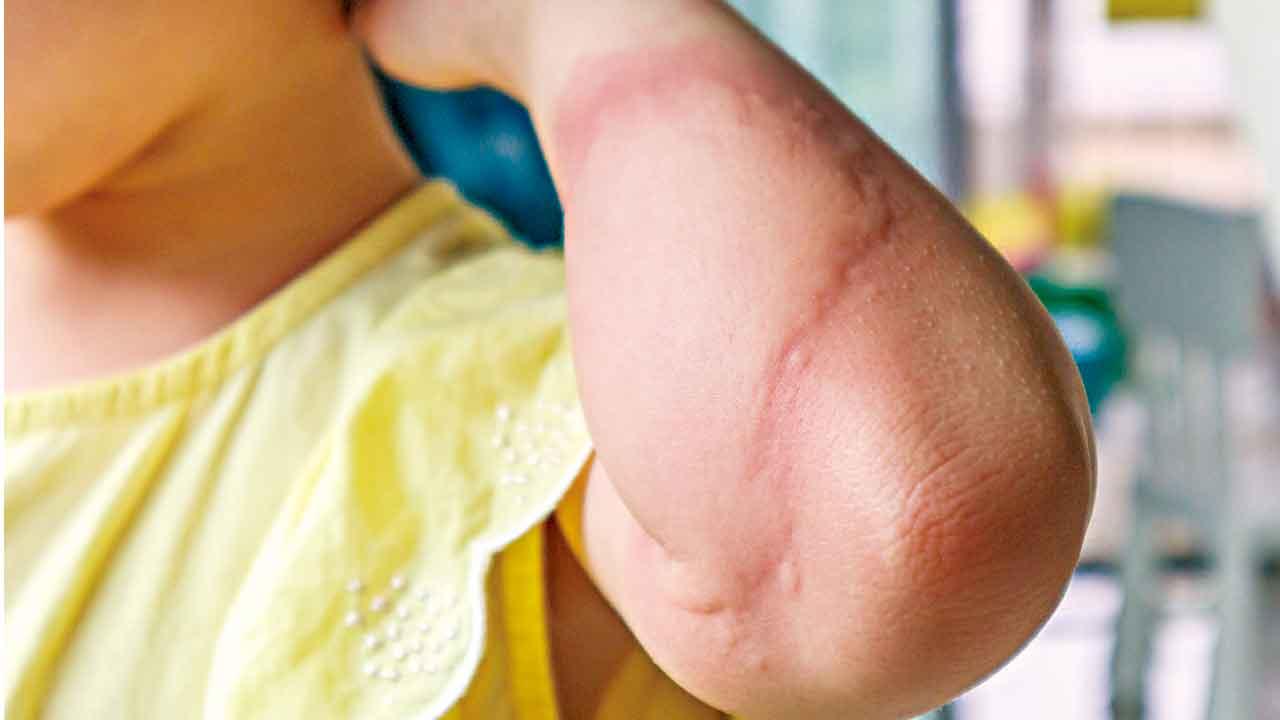 溫差大 幼童易誘發蕁麻疹