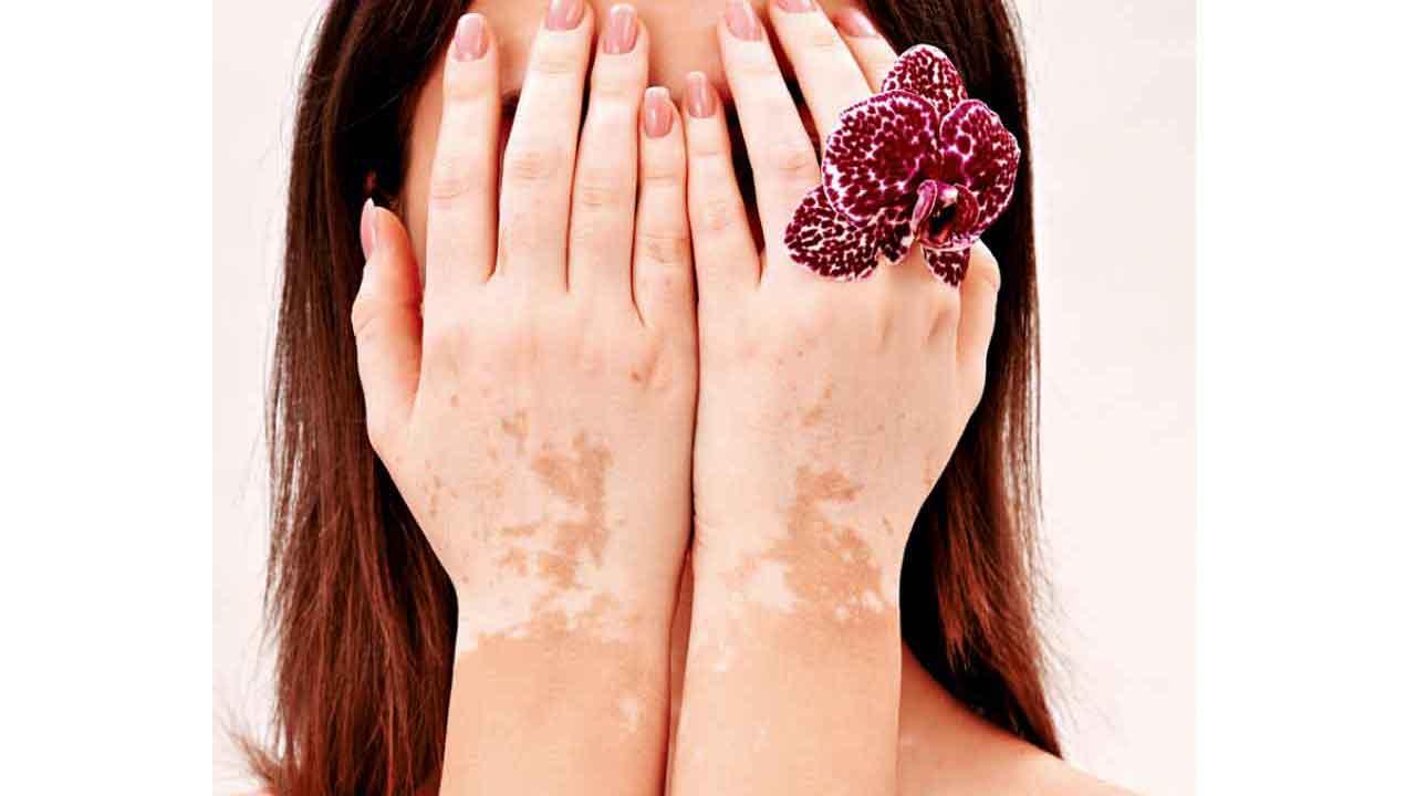 患白蝕 膚色有望復原