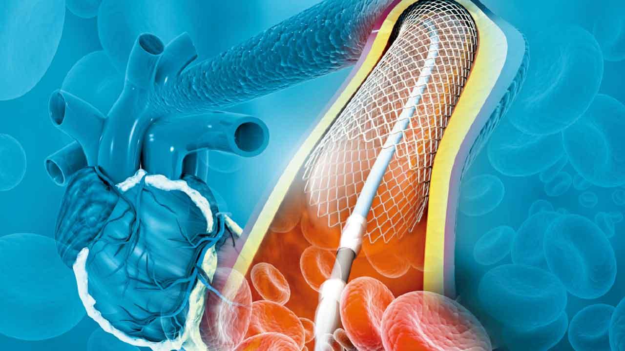 無視膽固醇問題 恐須通波仔 