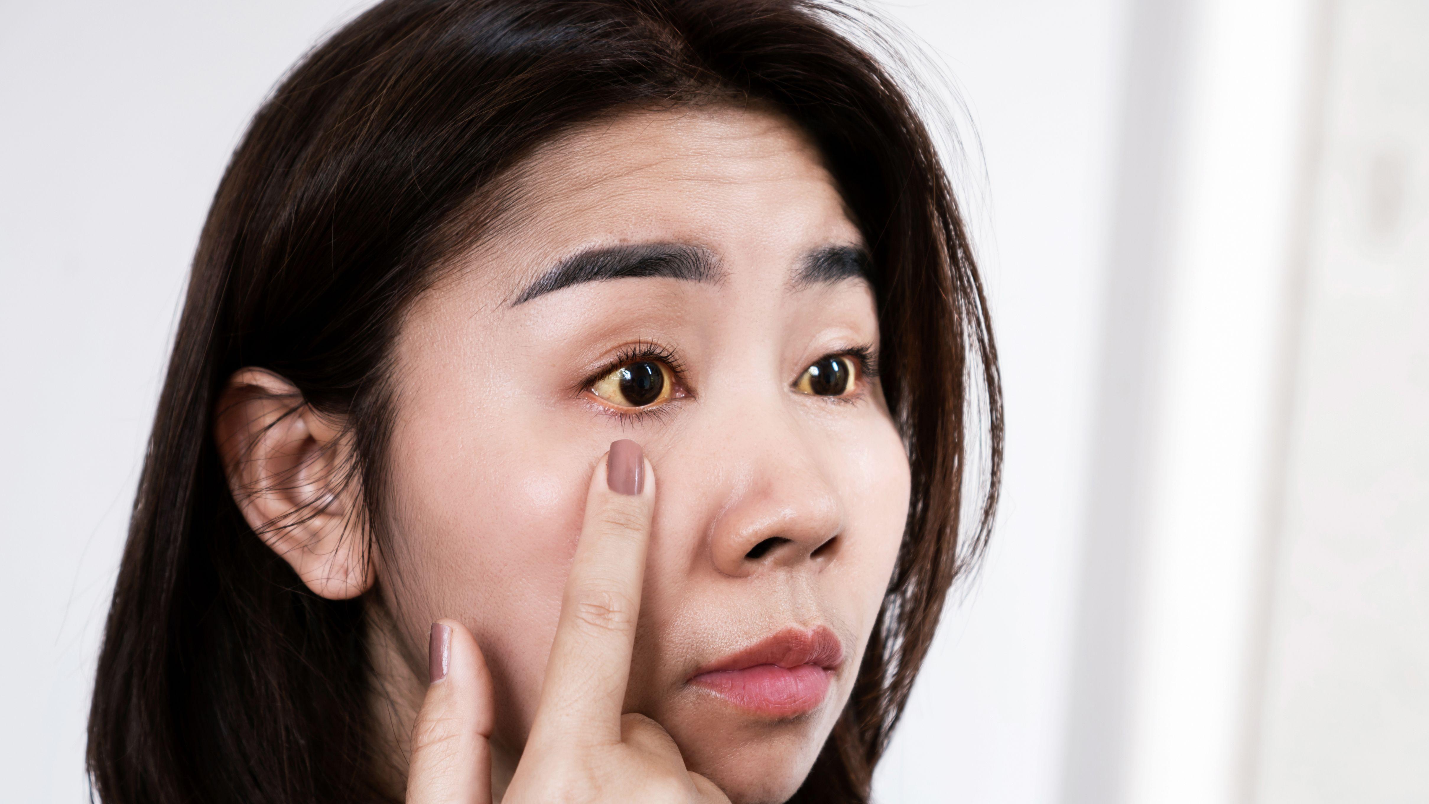 肝病 黃疸 皮膚變黃 皮膚 胡蘿蔔素血症 營養 胡蘿蔔素 維他命A 肝臟