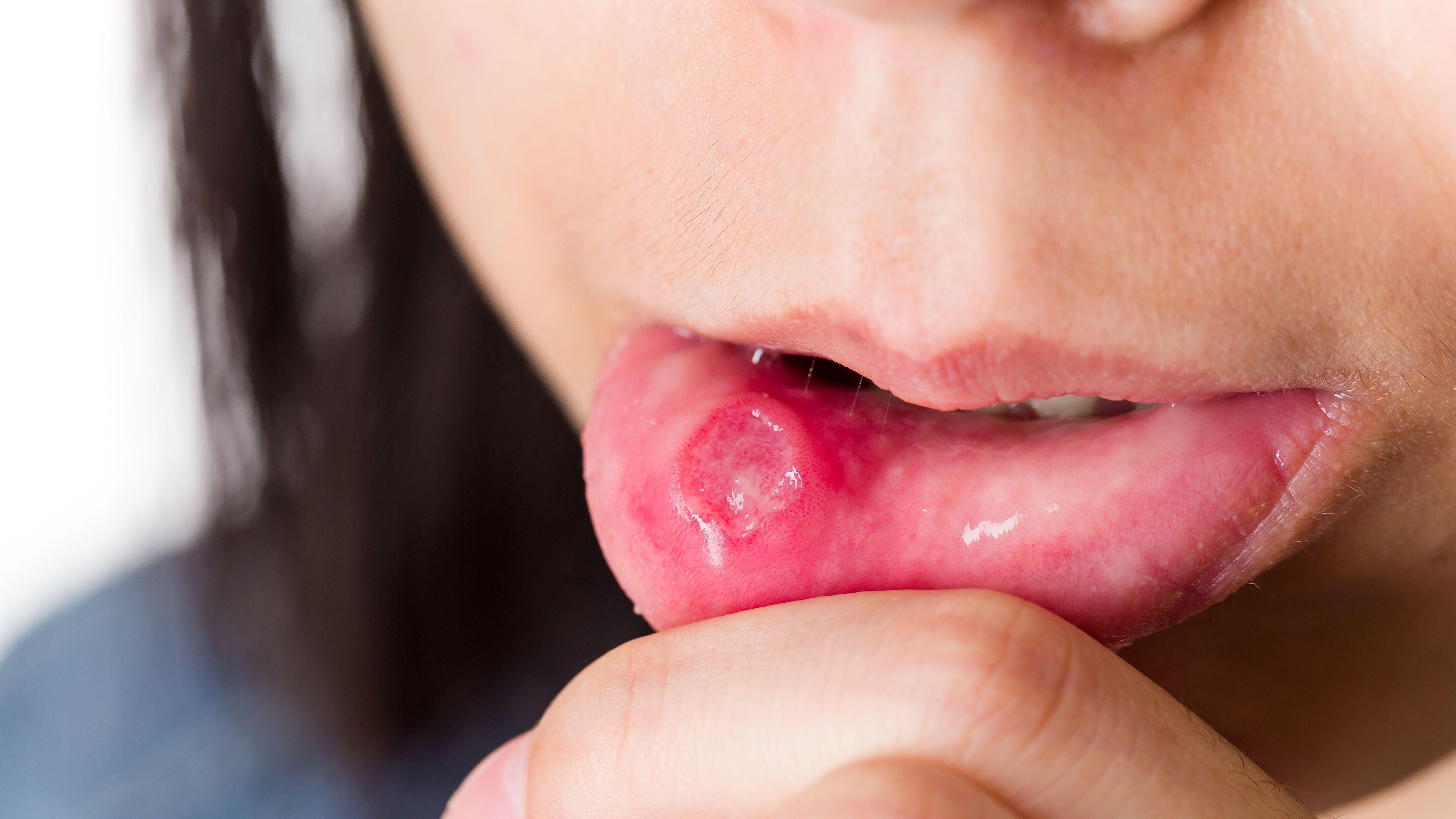 生痱滋 熱氣 營養 營養師 口腔潰瘍 營養素
