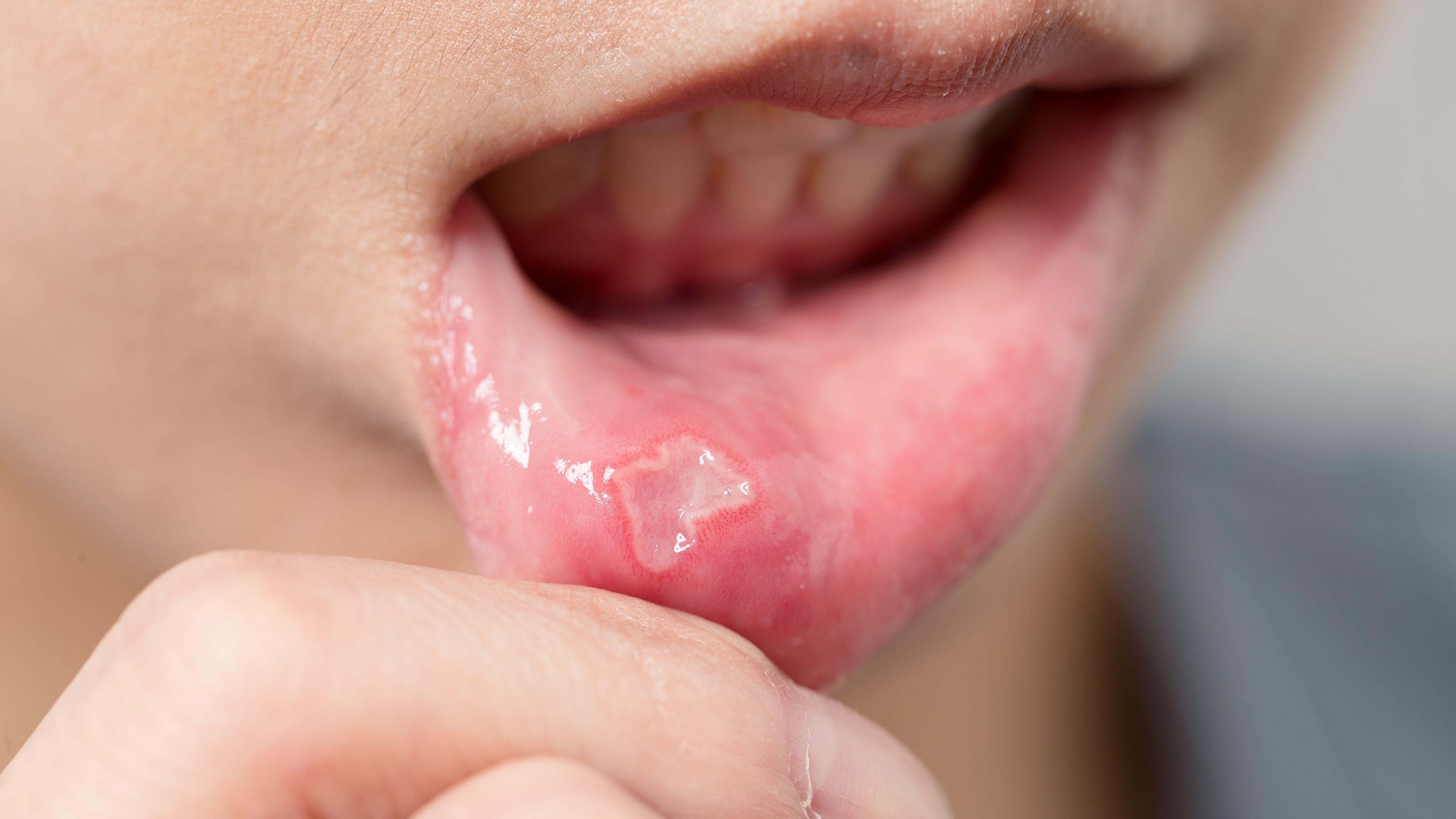 生痱滋 生唇瘡  唇瘡 痱滋  傳染性 熱氣 嘴巴疾病 唇皰疹 口角炎 口腔潰瘍