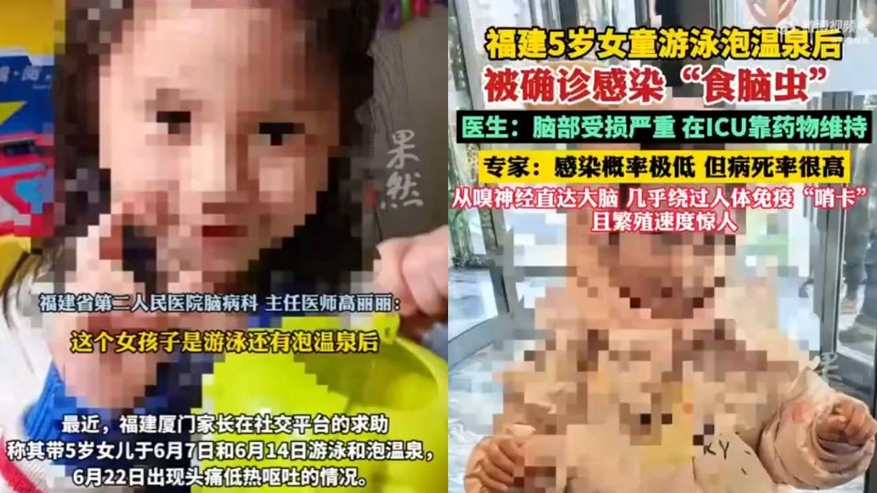 福建5歲女童戲水感染食腦蟲　醫生：死亡率達98%！