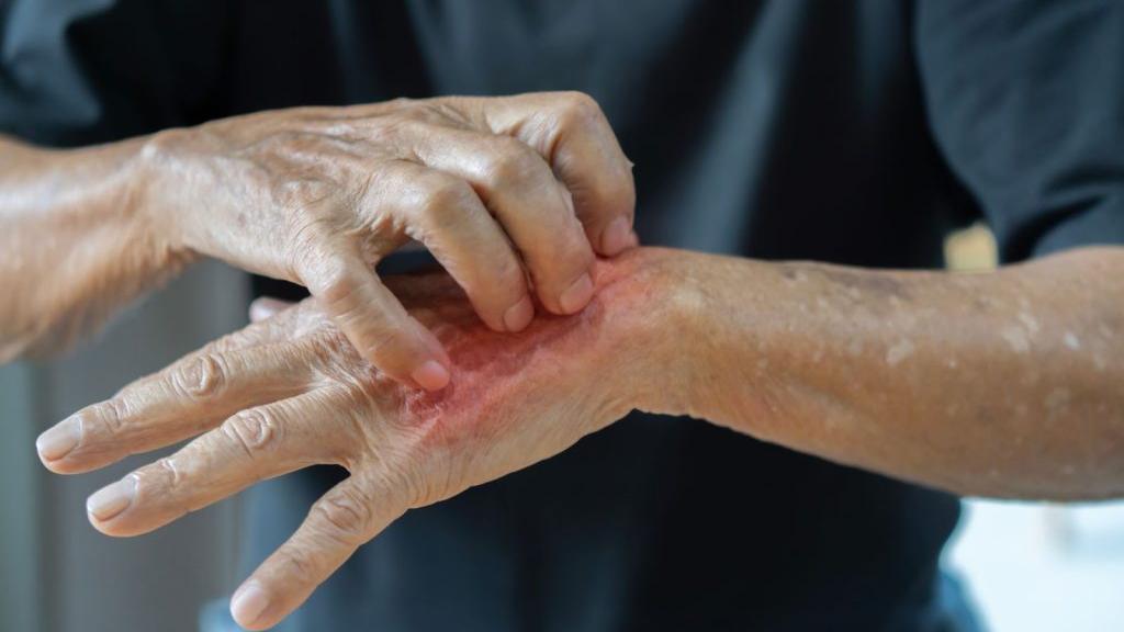 若出現長期未癒的全身性搔癢性紅疹，且同住家人也陸續出現類似症狀時，應警覺疥瘡感染之可能性，建議盡早就醫，由皮膚科醫生進行診斷與治療。